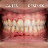 Antes y después — encías sanas